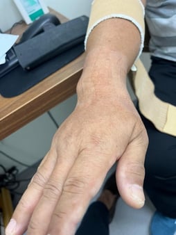 wrist fracture