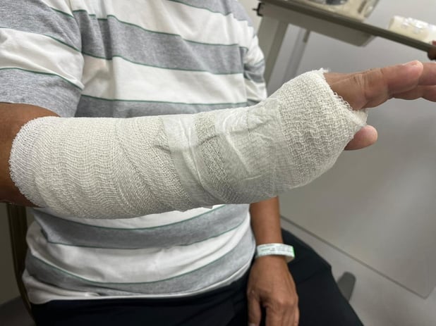 wrist fracture treatment