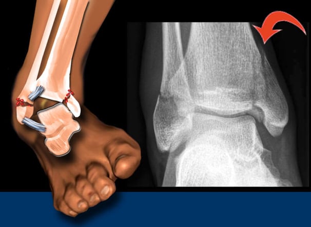 twisting-the-ankle
