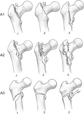 Intertrochanteric-fractures