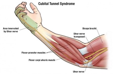 What is Cubital Tunnel Syndrome - Coastal Orthopedics