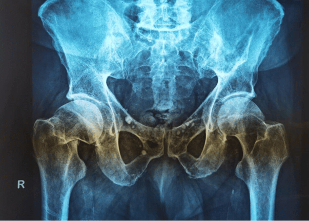 hip-xray