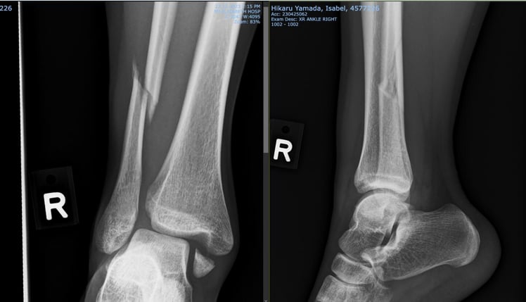 ankle-fracture-initial-x-ray