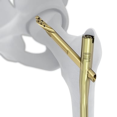 Intertrochanteric-fracture