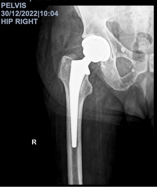 hip-replacement-after-fracture