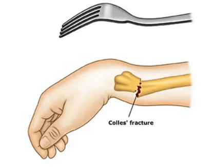 colles-fracture