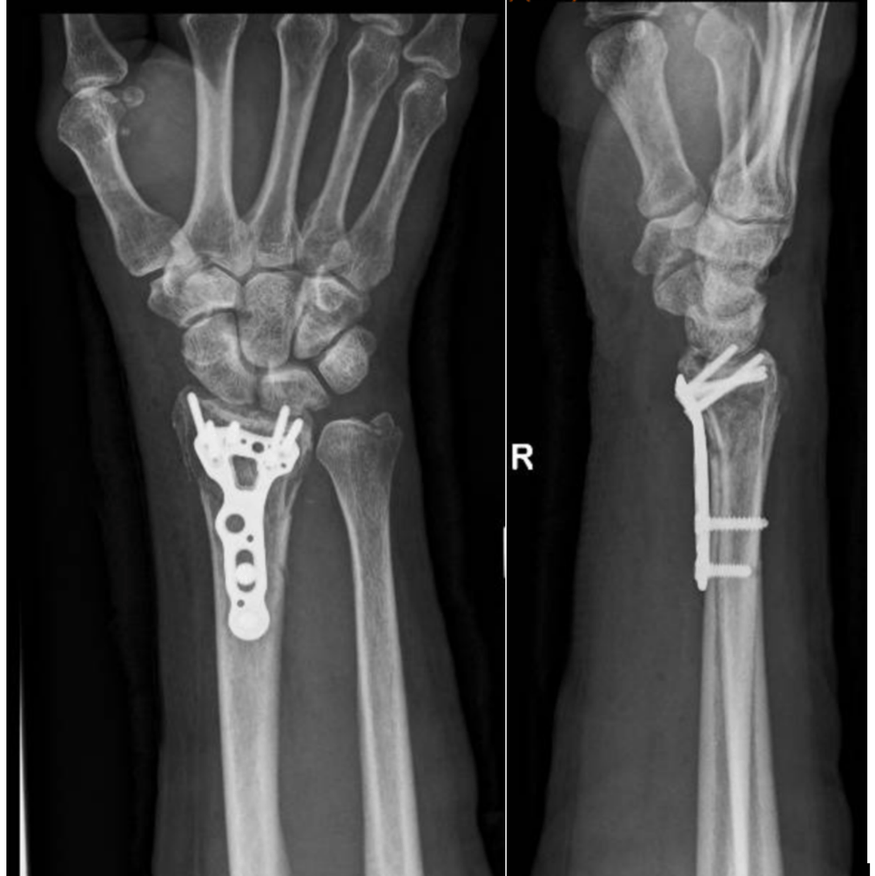 25600 Orion - Hand & Wrist Distal Radius Fractures