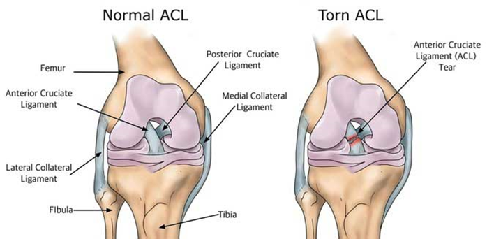 torn-anterior-cruciate-ligament-ACL