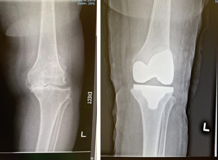 total knee replacement surgery with makoplasty