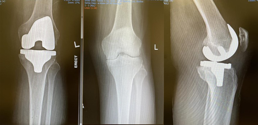 Total-Knee-Placement-Operation-3