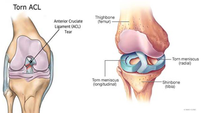 Total-Knee-Placement-Operation-5-1