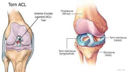 Total-Knee-Placement-Operation-5-1 Total-Knee-Placement-Operation-5-1