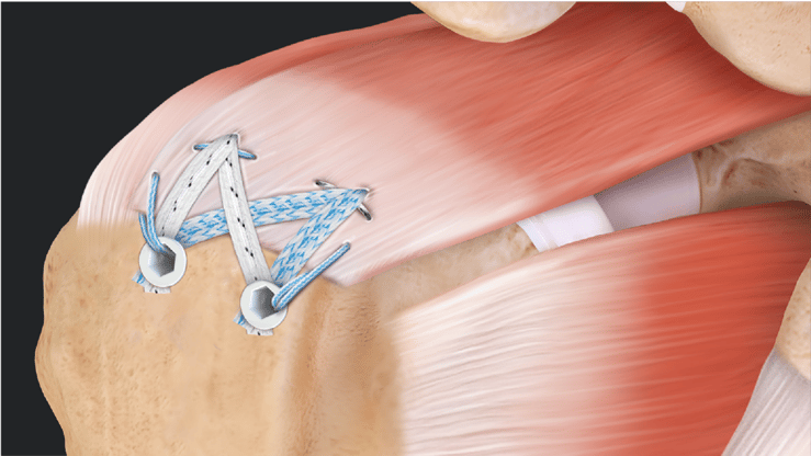 anchor_sutures_to_repair_rotator_cuff