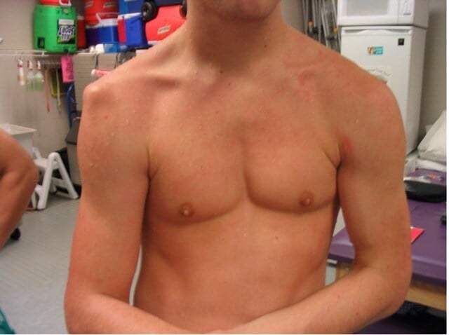 clinical shoulder dislocation