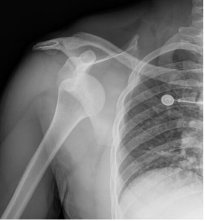 dislocated shoulder xray AP