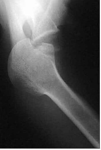 dislocated shoulder xray valpeau-1