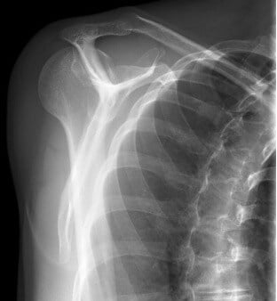 dislocated shoulder xray y scapular
