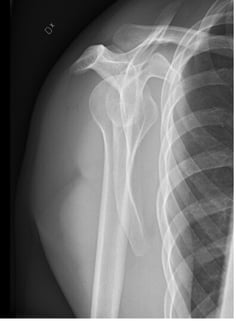 normal shoulder xray y scapular (1)