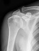 normal shoulder_1