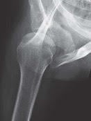 normal shoulder_3