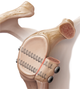 shoulder latarjet procedure