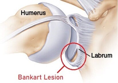 torn shoulder labrum bankart