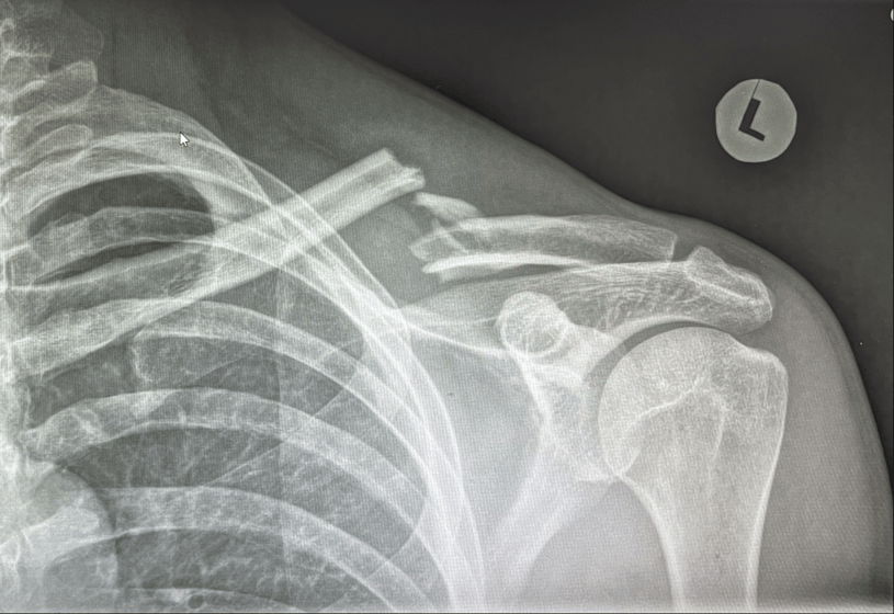 X-ray of a shoulder
