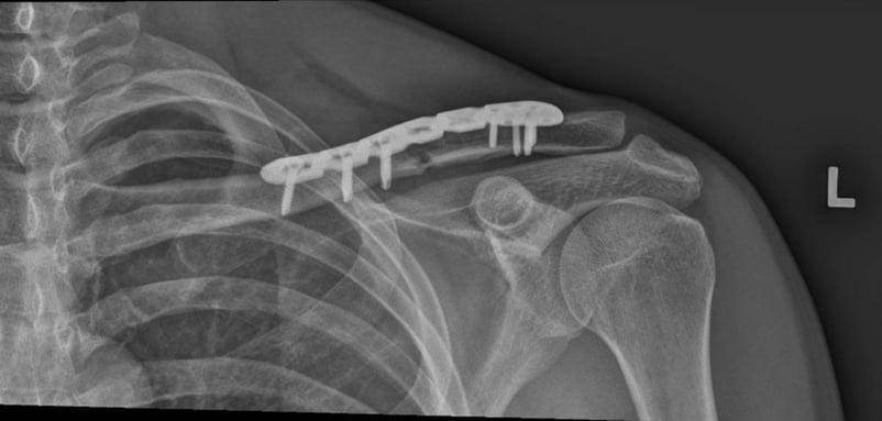 X-ray of a shoulder with a broken bone