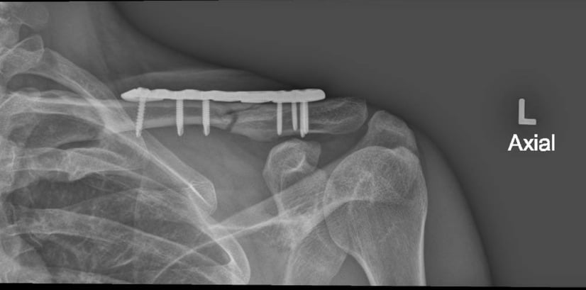 X-ray of a shoulder bone with screws