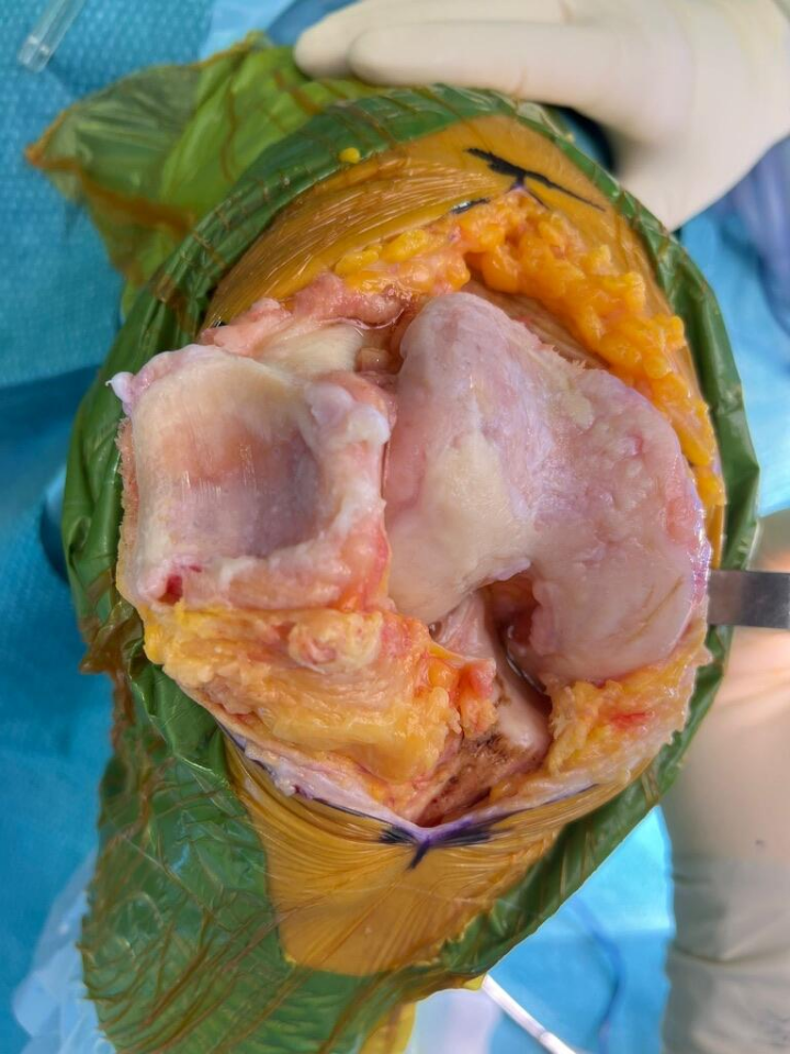 worn-out-knee-cartiliage