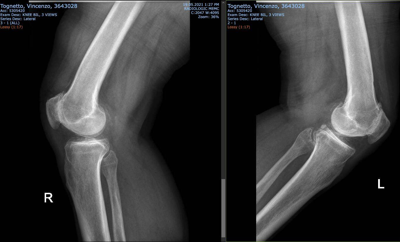 Orion knee 3 Orion knee 3