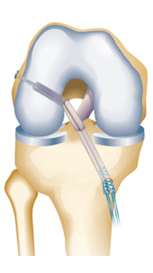 acl-reconstruction-in-singapore acl-reconstruction-in-singapore