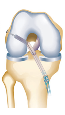 acl-reconstruction-in-singapore