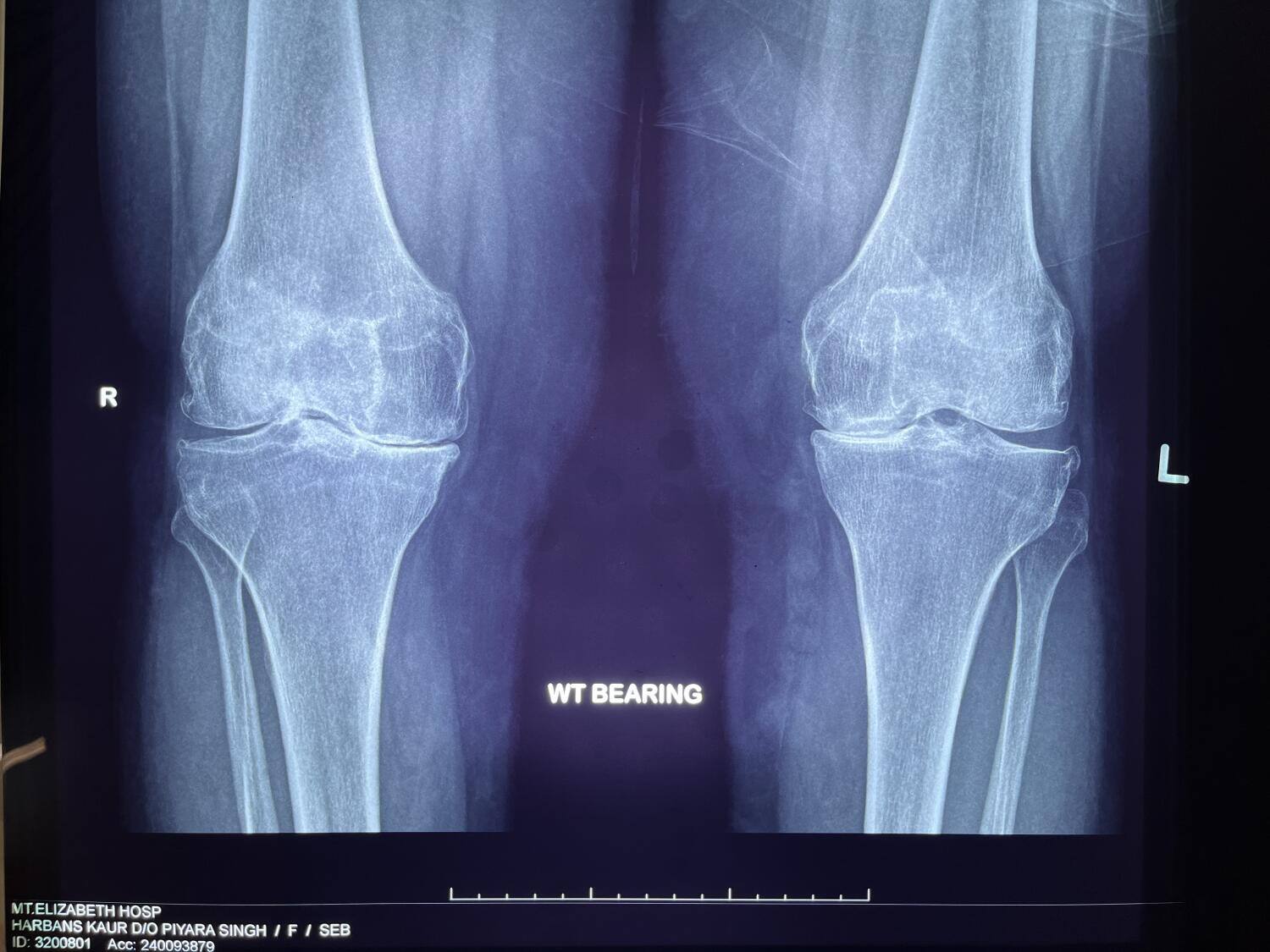 image 1 knee arthritis image 1 knee arthritis