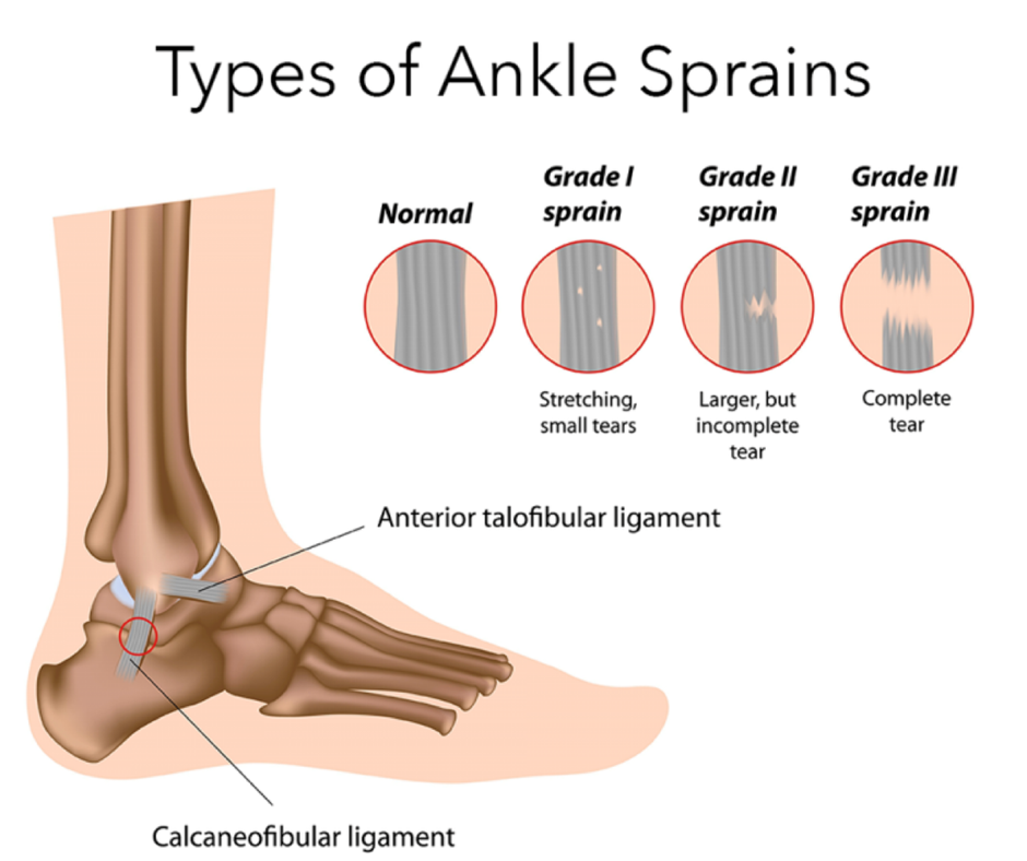 Treatments For Ankle Sprain & Injuries